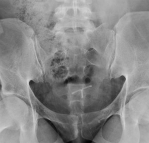 Figure 1B. 30-year-old female with sacral and lower back postpartum pain. The radiologist reading the outlet radiograph of the sacrum and coccyx noted a subtle cortical irregularity along the anterior cortical margin of the S3-S4 segment intervertebral level on the lateral view, suggesting possible nondisplaced fracture.